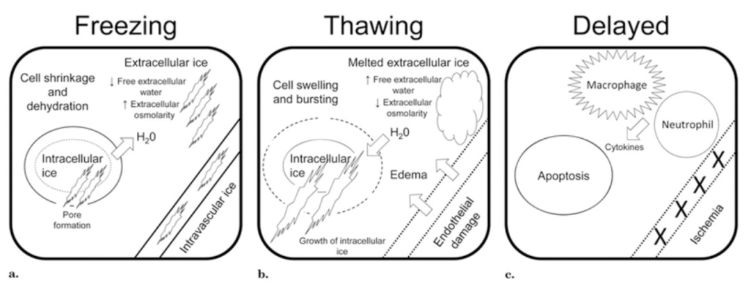 腫瘤治療界的「高冷之花」——腫瘤微創(chuàng)冷凍消融，國(guó)產(chǎn)替代設(shè)備空間巨大